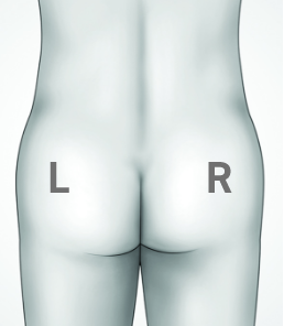 Illustration showing the left and right buttock, highlighting the need to alternate injection sites