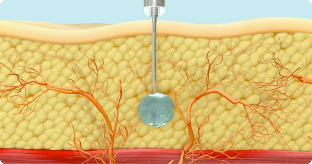 Illustration of the deep subcutaneous injection through which lanreotide is slowly released